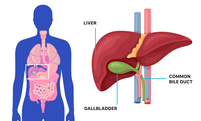 Contracted Gallbladder Diagnosis and Treatment